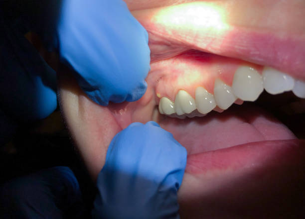 Best Dentist for Tooth Abscess  in Hazen, ND